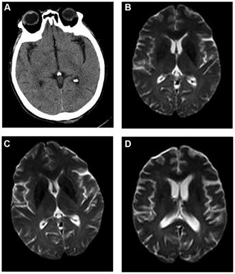 Case report: Autoimmune encephalomyelitis following cytomegalovirus infection after allogeneic hematopoietic stem cell transplantation